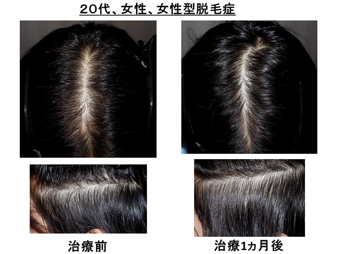 円形脱毛症　病院